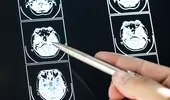 3 semne alarmante de accident vascular cerebral. Trebuie să suni urgent la 112