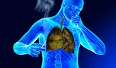 Primele semne de CANCER pulmonar. Unul se vede la analizele de sânge uzuale