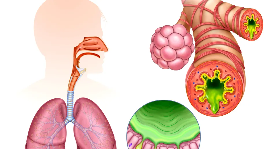 Cum să elimini mucusul din plămâni. 10 remedii naturale ca să nu mai suni la medic