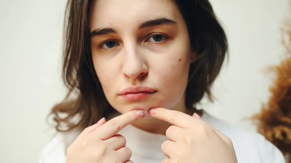 Metoda sigură prin care poți stoarce coșurile fără a-ți lăsa cicatrici pe piele