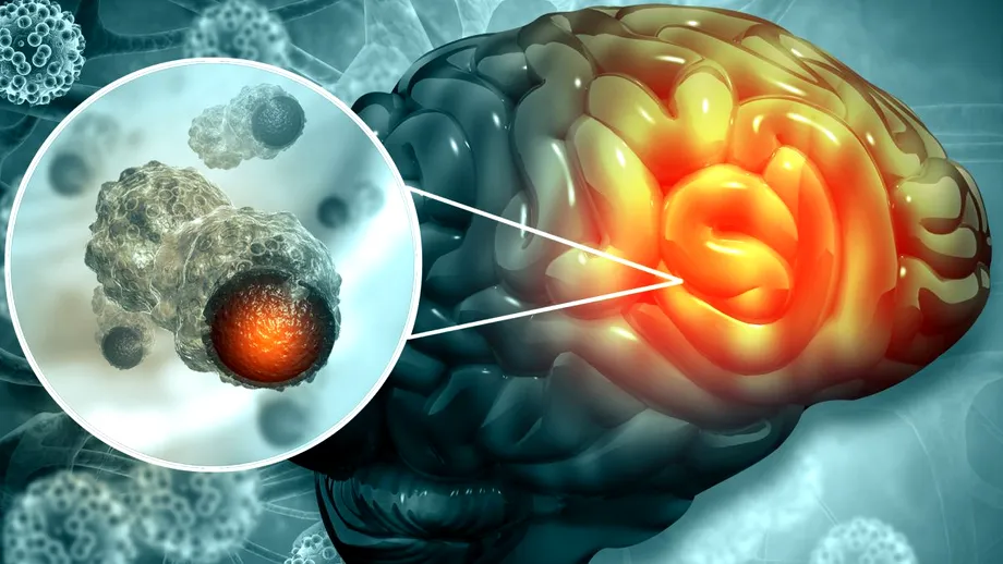 Lupta cu tumorile cerebrale. Cum ajută neuro-imagistica avansată la reducerea timpului de diagnosticare