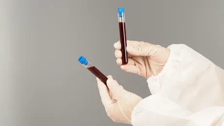 Cum să reduci trigliceridele prin dietă. Alimentul la care trebuie să renunți