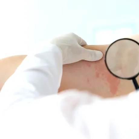 Cazuri de lepră în România! Cum se manifestă şi cum se tratează boala