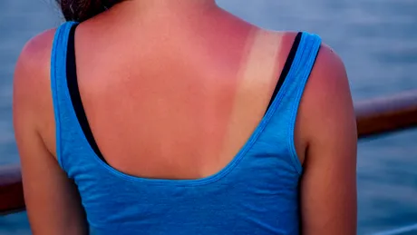 Cum să calmezi arsurile solare cu doar două ingrediente naturale