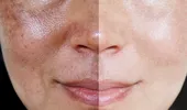 Ştergerea petelor şi a hiperpigmentărilor: tehnologii avansate şi remedii naturale pentru o piele perfectă