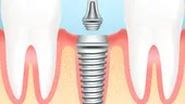 Implantul dentar: avantaje şi dezavantaje în raport cu alte metode de tratament
