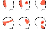 Ce înseamnă durerea de cap resimțită în tâmple, frunte sau în partea dreaptă și pastile pe care trebuie să le iei