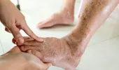 ​Picioare umflate, urină spumoasă și oboseală persistentă? Semne care pot indica probleme renale la persoanele cu diabet sau hipertensiune