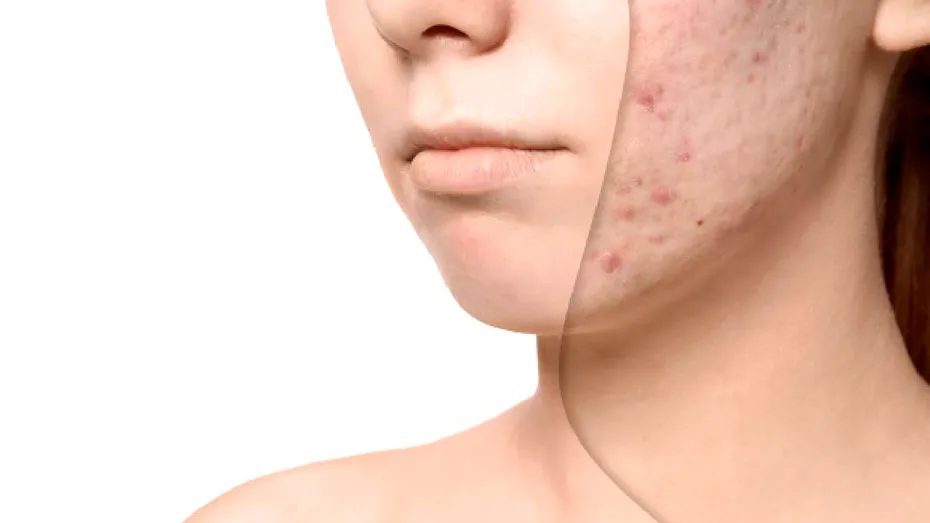 De ce apar petele pigmentare mai repede vara. Remedii naturale care uniformizează tenul