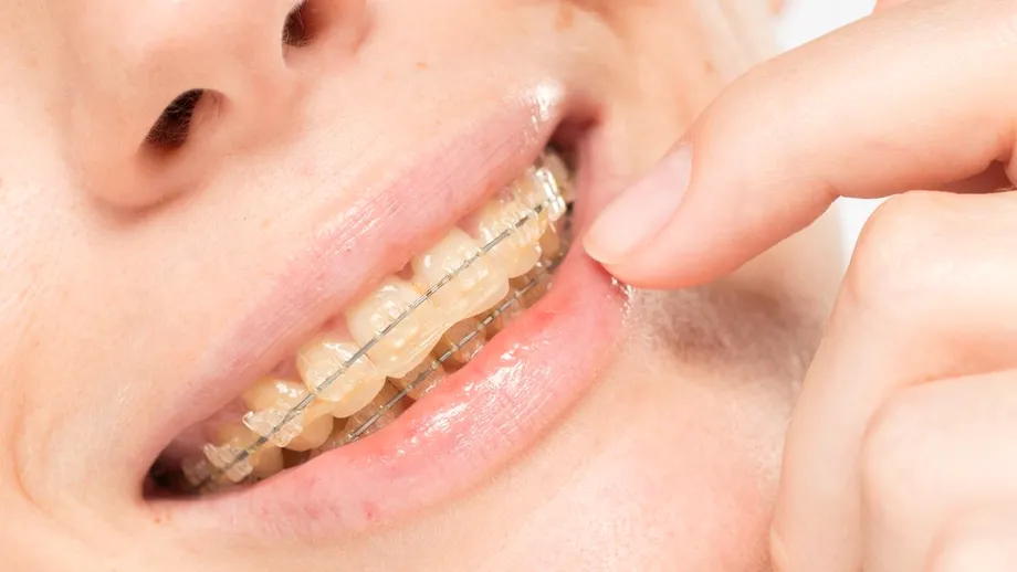 Cât costă un aparat dentar în funcție de materialul folosit