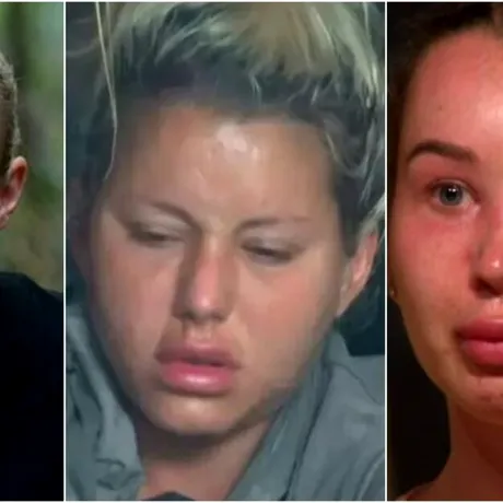 De ce li s-a umflat, de fapt, fața vedetelor de la „Survivor”? Adevărul din spatele transformărilor care au stârnit controverse