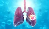 Care sunt cele mai indicate tratamente pentru cancerul pulmonar?