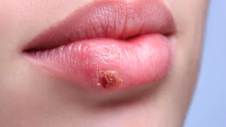 Ce este herpesul oral şi cum îl previi?