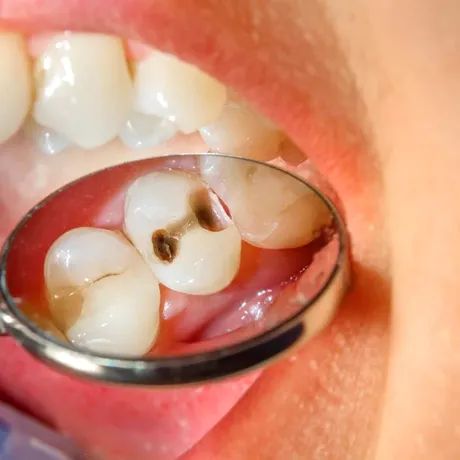 Știai că există mai multe tipuri de carii dentare și că cele negre nu sunt cele mai periculoase?