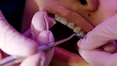 (P) 5 motive pentru care merită să alegi un aparat dentar din safir