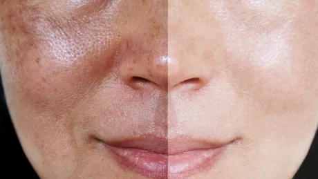 Ştergerea petelor şi a hiperpigmentărilor: tehnologii avansate şi remedii naturale pentru o piele perfectă