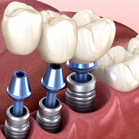 Dinți ficși în 24 de ore: mit sau realitate? Tot ce trebuie să știi dacă te-ai hotărât să-ți pui un implant dentar