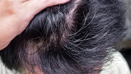 Albirea prematură a părului poate fi reversibilă. Ce spune specialistul