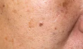 Pete maronii pe faţă: 10 cauze şi metode de tratament pentru petele pigmentare