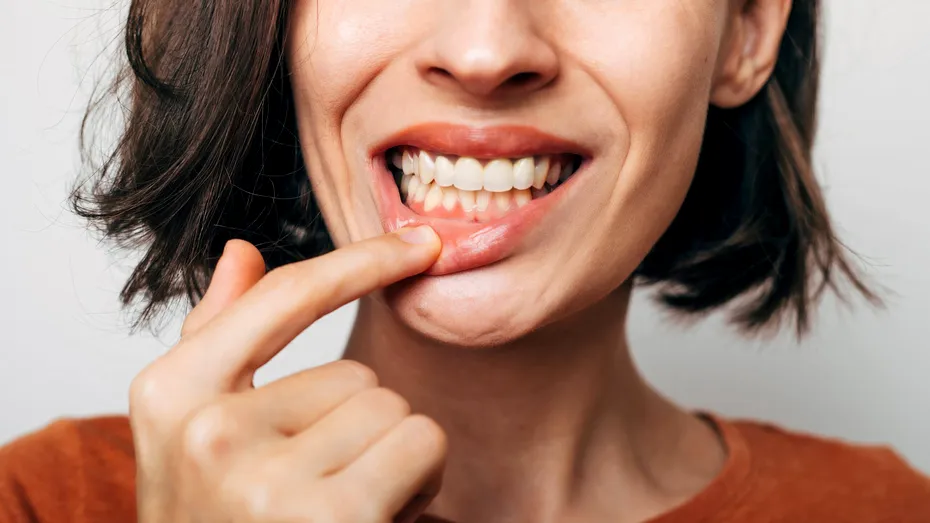 Trend pe TikTok: tinerii își zgârie dinții și gingiile ca să scape de tartru acasă. De ce este periculos!