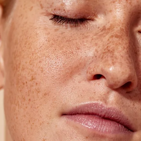 Petele întunecate de pe piele, semnale de alertă ale corpului. Cum te pot ajuta alimentația și antioxidanții să le estompezi