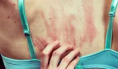 Cum recunoști insecta care te-a înțepat sau mușcat după felul în care arată pielea