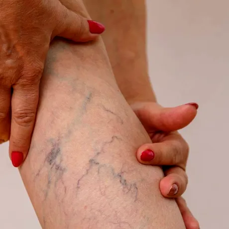 Leacuri pentru venele sparte de sub piele. Nu „șterg” instant vasele sparte, dar scapi de roșeață și inflamație