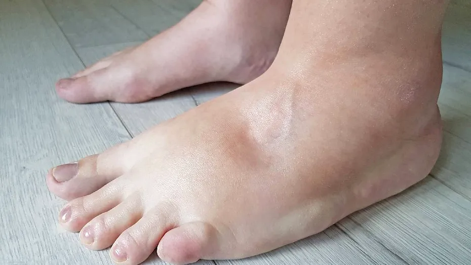 Corpul tău pare umflat fără motiv: adevărul despre retenția de apă