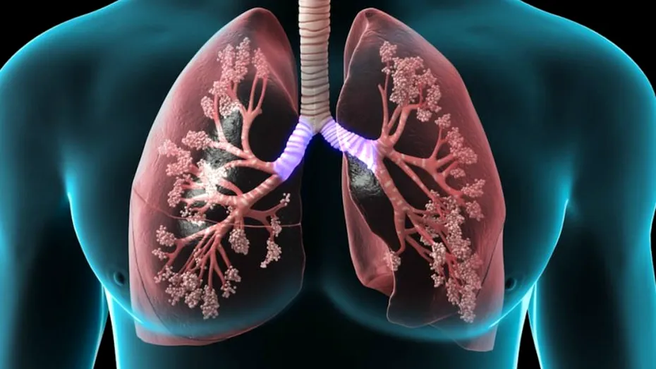 Edemul pulmonar: cauze, simptome, tratament