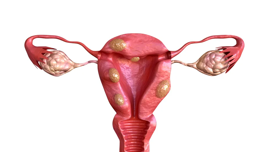 Fibrom uterin – 7 semne și simptome supărătoare