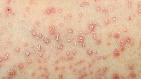 Lichen scleros şi atrofic: cauze, simptome, tratament