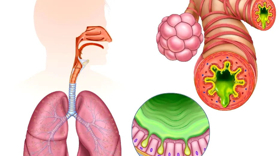 Inflamația cronică: „dușmanul invizibil” al sănătății moderne