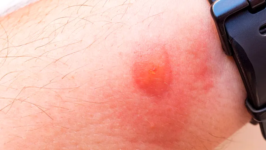 Mușcătura de insectă mai periculoasă și dureroasă decât cea de țânțar. Ce trebuie să faci dacă ai fost mușcat