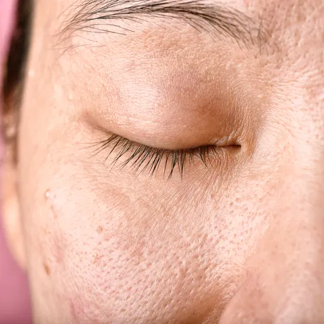 Cum diferențiezi porii deschiși de cei închiși. Îngrijirea corectă a tenului începe acasă