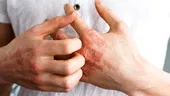 Cum își pot gestiona pacienții cu psoriazis simptomele în sezonul rece. Recomandările medicului dermatolog