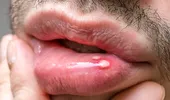 Cum scapi mai repede de afte. Remediile naturale care calmează durerea și grăbesc vindecarea