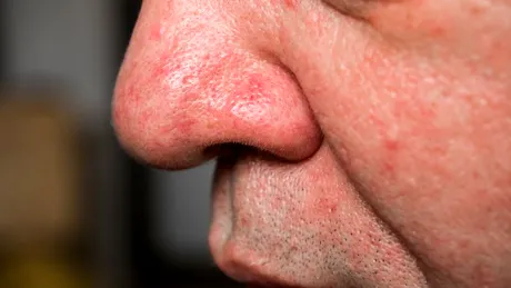 Ce înseamnă dacă ai pete roșii pe nas. Ai grijă - pot ascunde probleme cu ficatul sau chiar forme grave de cancer!