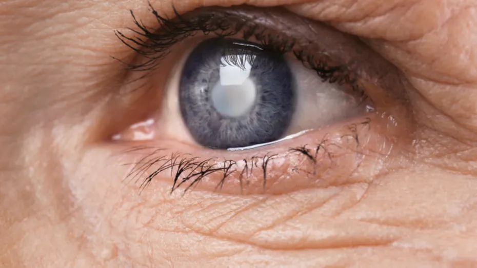 Operația de cataractă - cât costă în România?