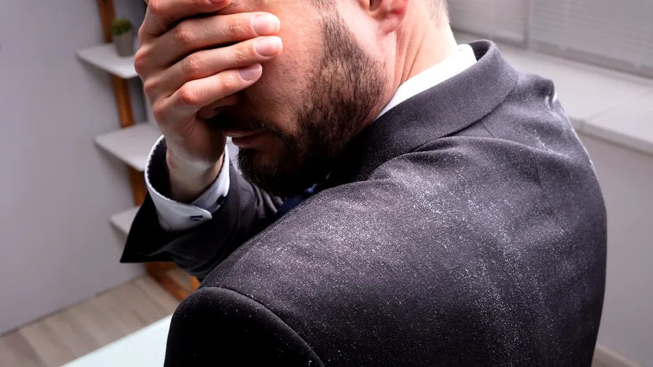 Cum să elimini mătreața din barbă! 3 metode eficiente pentru a scăpa de problema jenantă