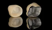 3 tipuri de coroane dentare: care e cea mai bună?