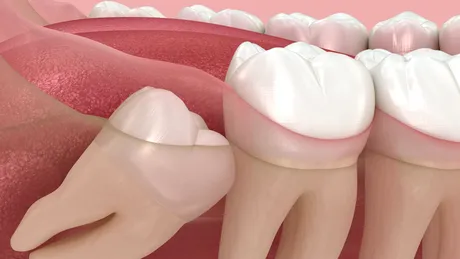 Măselele de minte - ce probleme pot cauza, când trebuie scoase și când să le lăsăm în pace