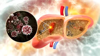 O dietă populară, vinovată pentru cancerul hepatic. Accelerează apariția lui prin „reprogramarea” celulelor hepatice