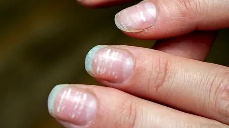 Ce boli grave semnalează petele albe pe unghii