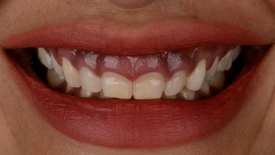 Gingivectomia sau corectarea zâmbetului gingival - în ce constă procedura?