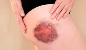 De ce apar vânătăi fără să te lovești? Când sunt normale și când pot ascunde o problemă de sănătate