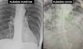 Plămâni de fumător versus plămâni COVID: cum arată radiografia pulmonară în cele 2 situații