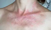 Ce boli de piele sunt declanșate sau agravate de expunerea prelungită la soare