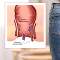Ce să mănânci pentru a reduce riscul de cancer colorectal. Alimentele recomandate la micul dejun, prânz și cină și ce ar trebui să eviți