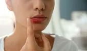 Metoda “secretă” cu care medicii scapă de herpesul de la gură peste noapte. Trucul care te ajută să nu mai apară când răcești