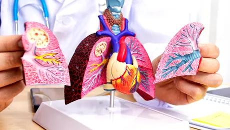 Avertismentul medicilor: Pneumonia este prima dintre cauzele infecțioase de deces!